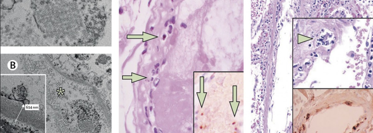 Infección de células endoteliales y endotelitis en COVID-19